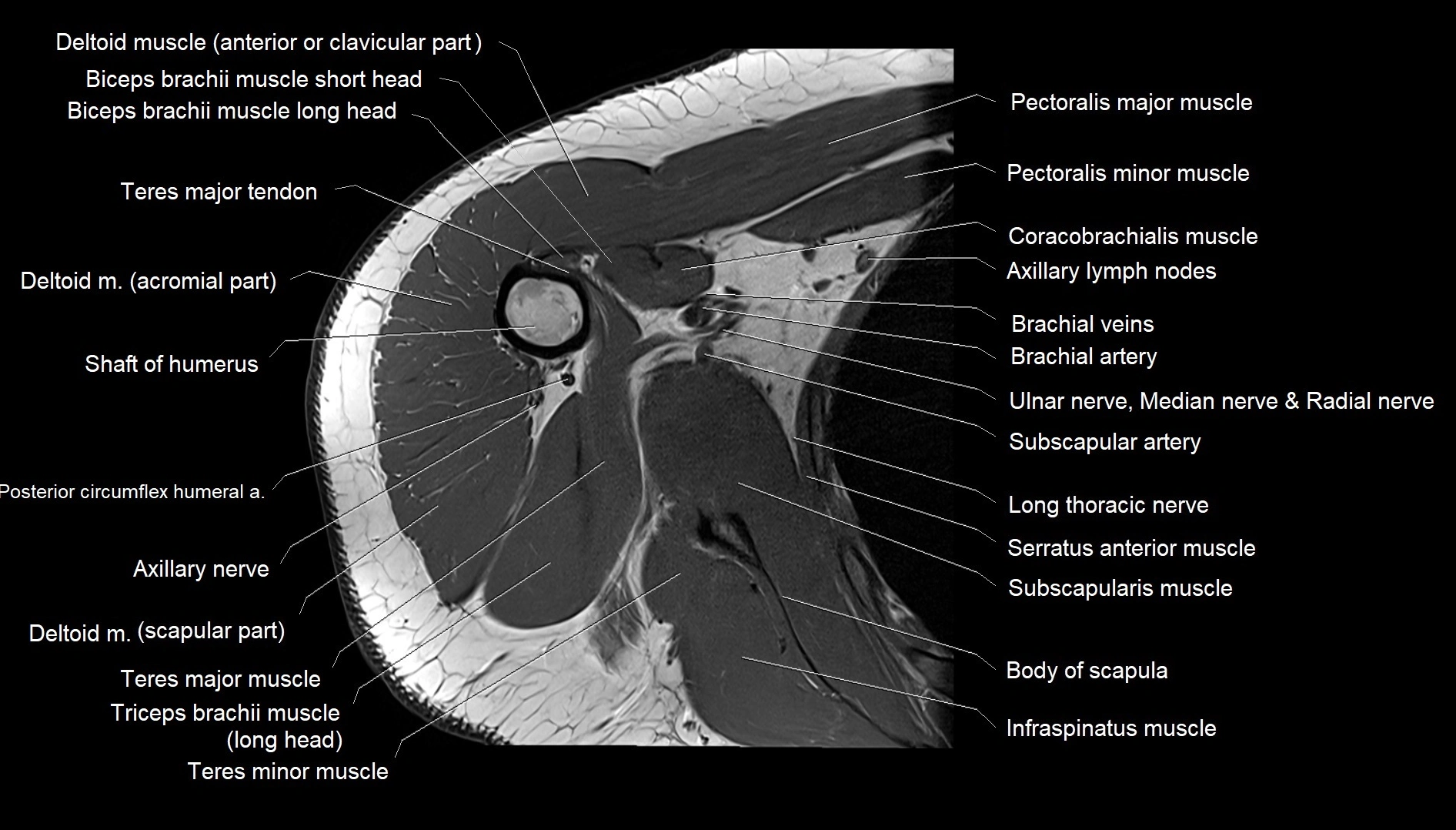 Shoulder cross sectional anatomy MRI 3T axial image 33.webp